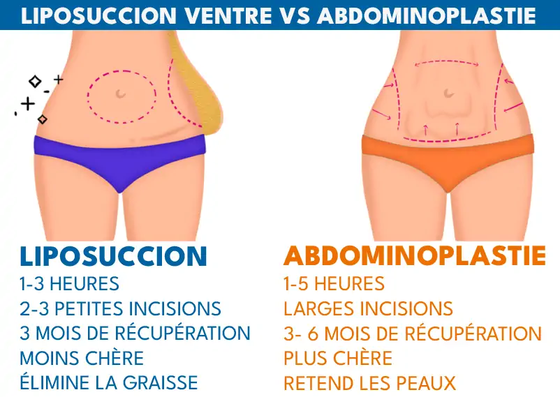 Liposuccion ou abdominoplastie Tunisie
