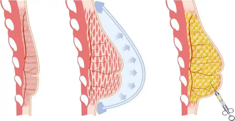 Lipofilling mammaire Tunisie