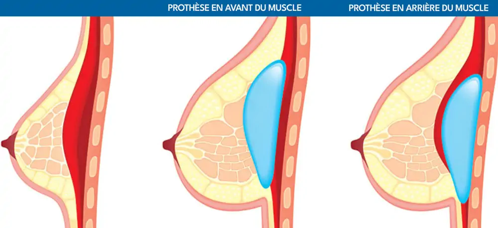 Prothèses mammaires Tunisie