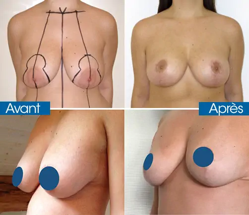Reduction mammaire Turquie