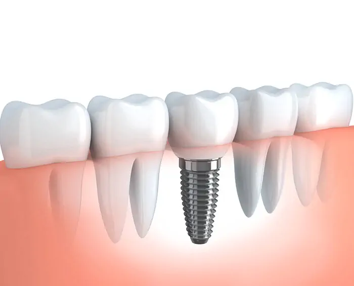 Implants dentaires Turquie