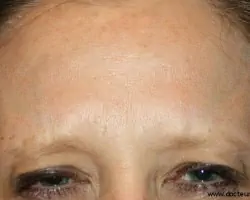 Botox Tunisie Tunisie